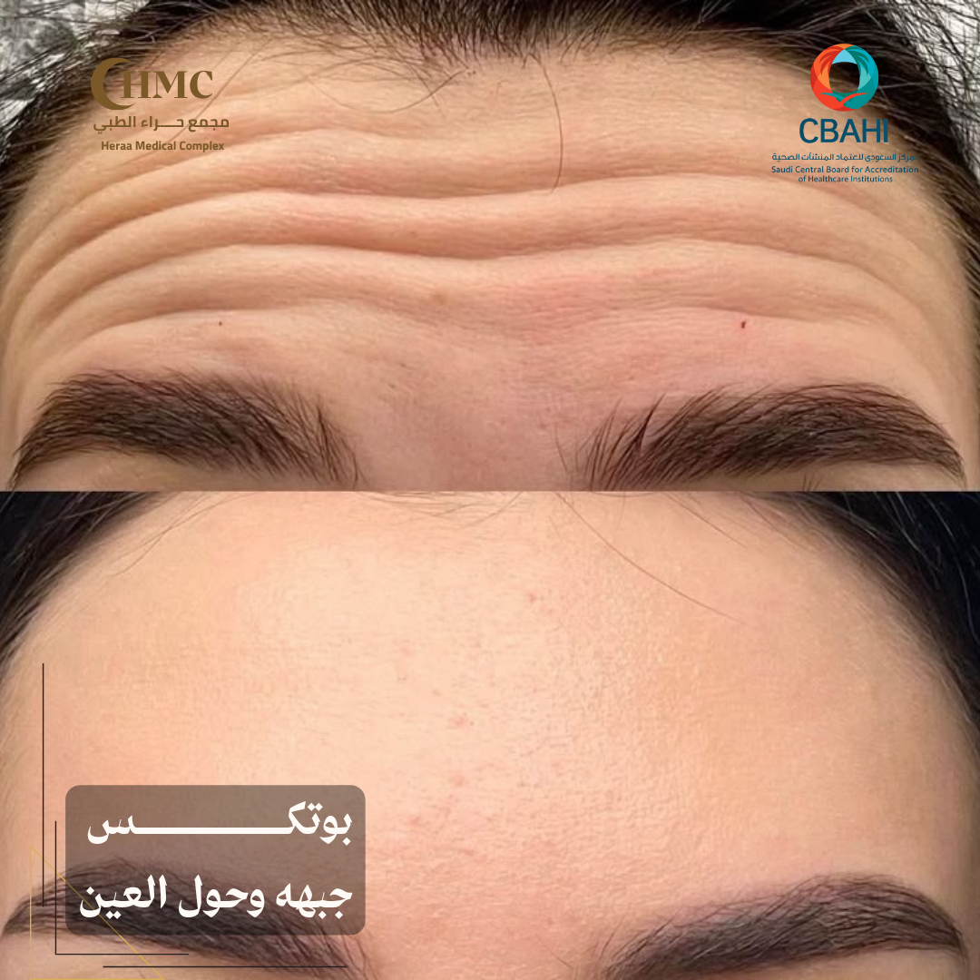 بوتكس الجبهه وحول العين 